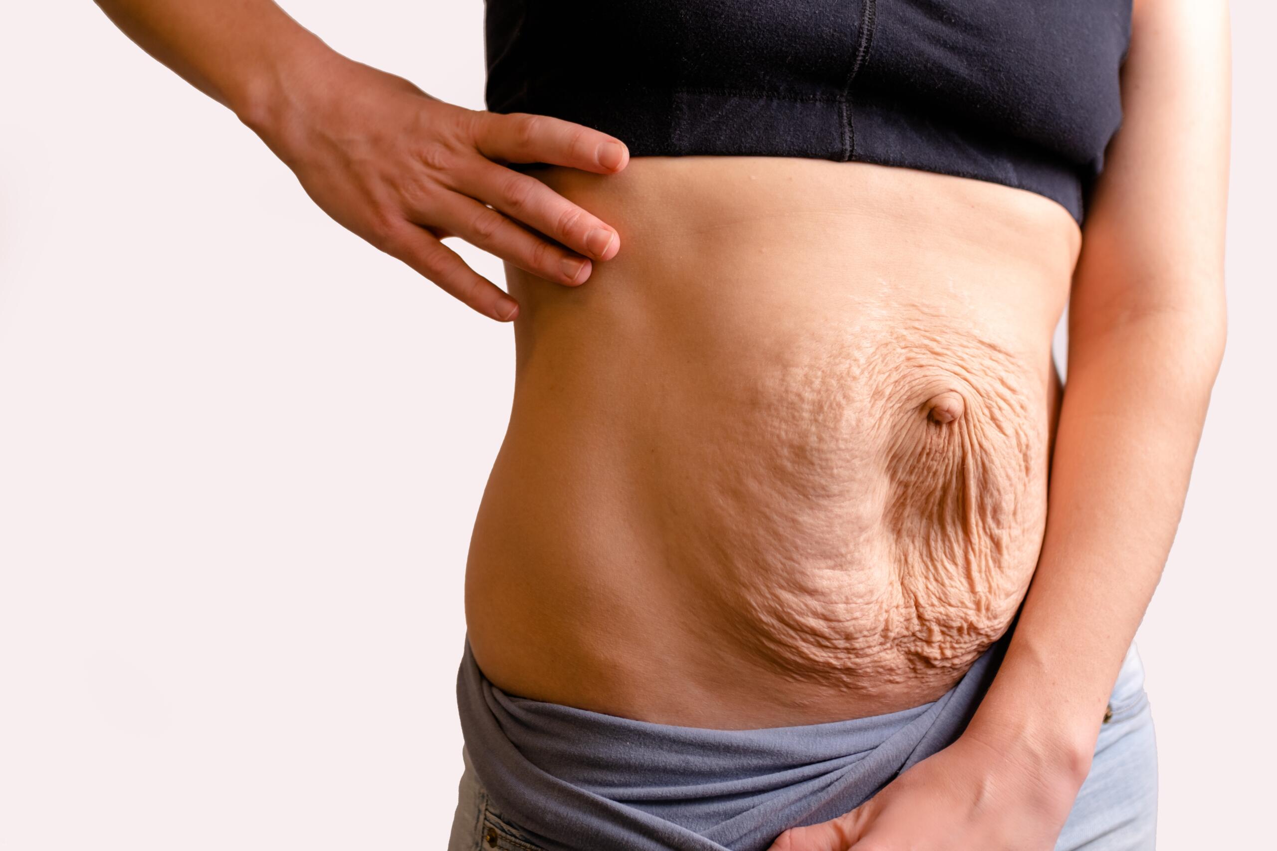 Diastasis abdominal